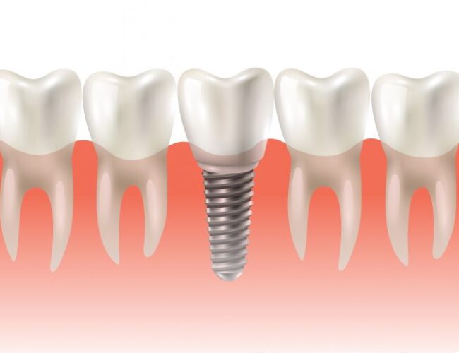 Na hora do implante dentário é necessário enxerto ósseo? instituto novva