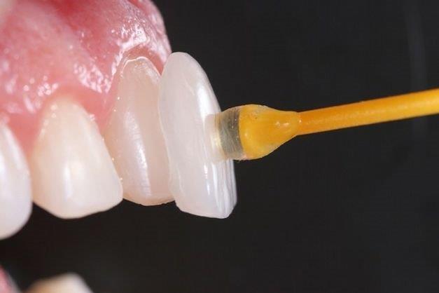 Saiba mais sobre as facetas dentárias instituto novva