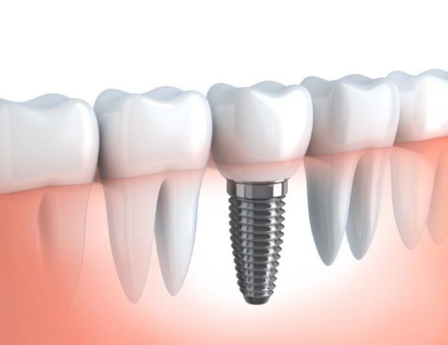 Quando é necessário um implante dentário? instituto novva