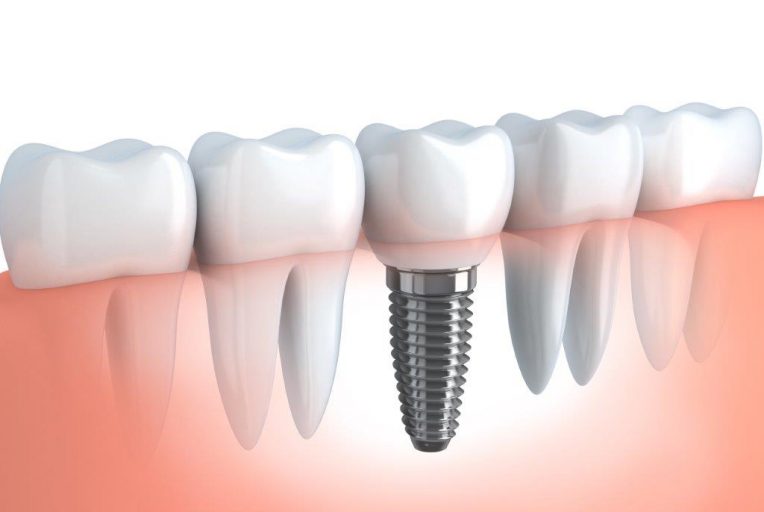 Quando é necessário um implante dentário? instituto novva