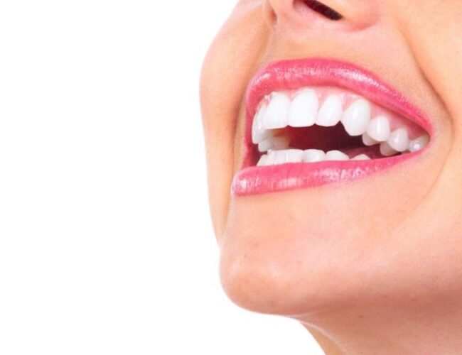 remoção do siso instituto novva