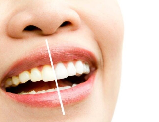 Clareamento dental é opção de tratamento estético instituto novva