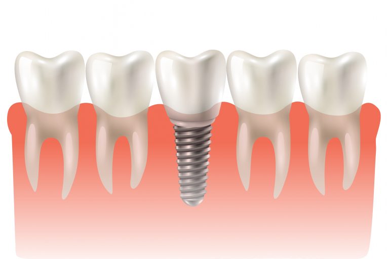 Na hora do implante dentário é necessário enxerto ósseo? instituto novva