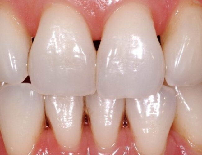 O espaço vazio entre os dentes pode ser um problema instituto novva