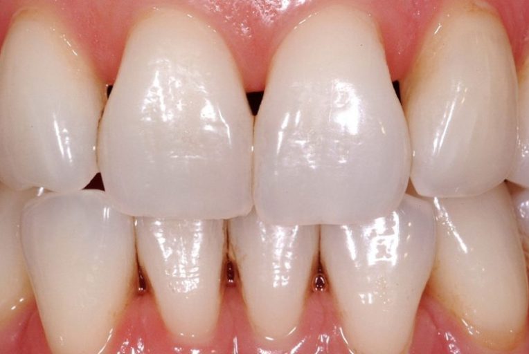 O espaço vazio entre os dentes pode ser um problema instituto novva